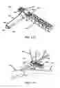 Fig. 35 - Systems and methods for intramedullary nail implantation