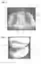 Fig. 02 - Orthodontic appliance for dentistry
