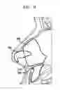 Fig. 10 - PROSTHESIS FOR NOSE SURGERY