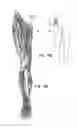 Fig. 11 - System and method for treatment of pain related to limb joint replacement surgery
