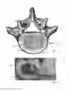 Fig. 02 - System for distracting and measuring an intervertebral space