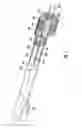 Fig. 09 - Devices and methods for fluid distribution from a catheter