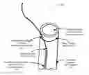 Fig. 01 - Modified fixed flat wire bifurcated catheter and its application in lower extremity interventions