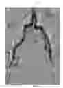Fig. 03 - Modified fixed flat wire bifurcated catheter and its application in lower extremity interventions
