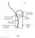 Fig. 04 - Modified fixed flat wire bifurcated catheter and its application in lower extremity interventions