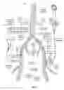 Fig. 06 - Modified fixed flat wire bifurcated catheter and its application in lower extremity interventions