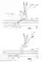 Fig. 06 - Rapid insertion integrated catheter and method of using an integrated catheter