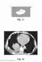 Fig. 05 - Method and System for Irradiating a Patient's Tumor