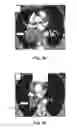 Fig. 12 - Method and System for Irradiating a Patient's Tumor