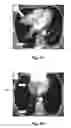 Fig. 13 - Method and System for Irradiating a Patient's Tumor