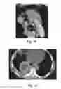 Fig. 06 - Method and System for Treatment of a Patient's Tumor