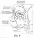 Fig. 02 - Ophthalmic artery therapy under reverse flow