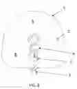 Fig. 03 - NOVEL ENHANCED ORB-LIKE INTRASACULAR DEVICE