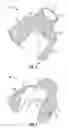 Fig. 04 - Void filling joint prosthesis and associated instruments