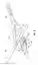Fig. 12 - Void filling joint prosthesis and associated instruments