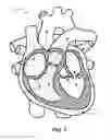 Fig. 02 - Mitral Heart Valve Replacement