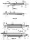 Fig. 06 - Pushable implant delivery system