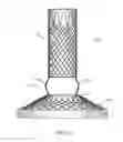Fig. 35 - Fixation of intraluminal device