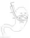 Fig. 01 - Automatic-sealing balloon-filling catheter system