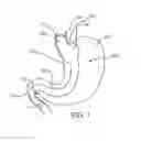 Fig. 02 - GASTRIC BYPASS DEVICE