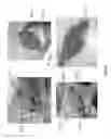 Fig. 22 - WOUND CLOSURE DEVICES