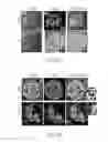 Fig. 08 - Use of aldehyde dehydrogenase as biomarker for beta-cell dysfunction and loss