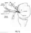 Fig. 09 - Surgical constructs and methods of tissue repair