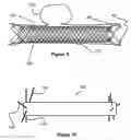 Fig. 07 - Stent and stent delivery device