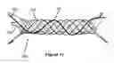Fig. 08 - Stent and stent delivery device
