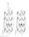 Fig. 08 - Radially adjustable stent graft delivery system and method of use