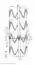 Fig. 09 - Radially adjustable stent graft delivery system and method of use
