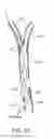 Fig. 09 - Systems and methods for treating a carotid artery