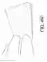 Fig. 45 - Intragastric device