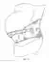 Fig. 41 - Methods and devices for reducing pregnancy-related and post-natal lower back pain