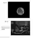 Fig. 02 - Macro-encapsulated therapeutic cells, devices, and methods of using the same