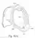 Fig. 85 - Delivery of respiratory therapy using conduits with varying wall thicknesses