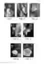 Fig. 02 - Methods and compositions for in-situ polymerization reaction to improve shale inhibition
