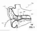 Fig. 02 - Method to estimate hearing impairment compensation function