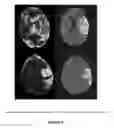 Fig. 09 - System and methods for assessing presence of large vessel occlusion to aid in transfer decision-making for endovascular treatment in patients with acute ischemic stroke