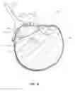 Fig. 06 - Ultrasound compatible inflatable vascular compression and related systems and methods