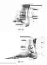 Fig. 25 - Knee instruments and methods