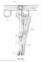 Fig. 40 - Knee instruments and methods