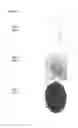 Fig. 03 - UROLITH CAPTURE AND RETRIEVAL DEVICE FOR URINARY TRACT STONES