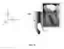 Fig. 22 - Fabrication and installation of a dental implant