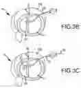 Fig. 07 - Trans-catheter ventricular reconstruction structures, methods, and systems for treatment of congestive heart failure and other conditions