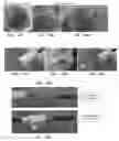 Fig. 43 - Trans-catheter ventricular reconstruction structures, methods, and systems for treatment of congestive heart failure and other conditions