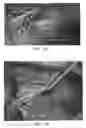 Fig. 49 - Trans-catheter ventricular reconstruction structures, methods, and systems for treatment of congestive heart failure and other conditions