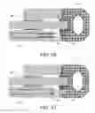 Fig. 14 - Stand-alone interbody fusion