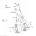 Fig. 02 - Bone joint replacement and repair assembly and method of repairing and replacing a bone joint