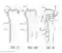 Fig. 09 - Bone joint replacement and repair assembly and method of repairing and replacing a bone joint